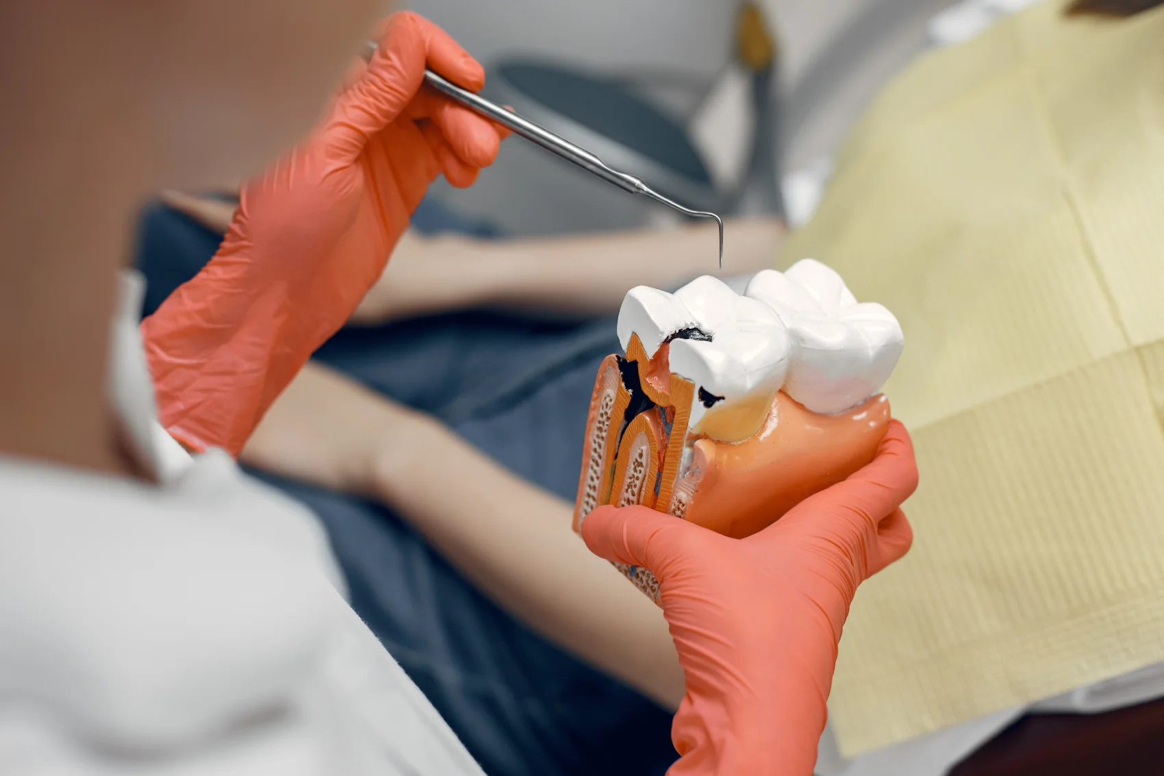 Qué son las caries dentales